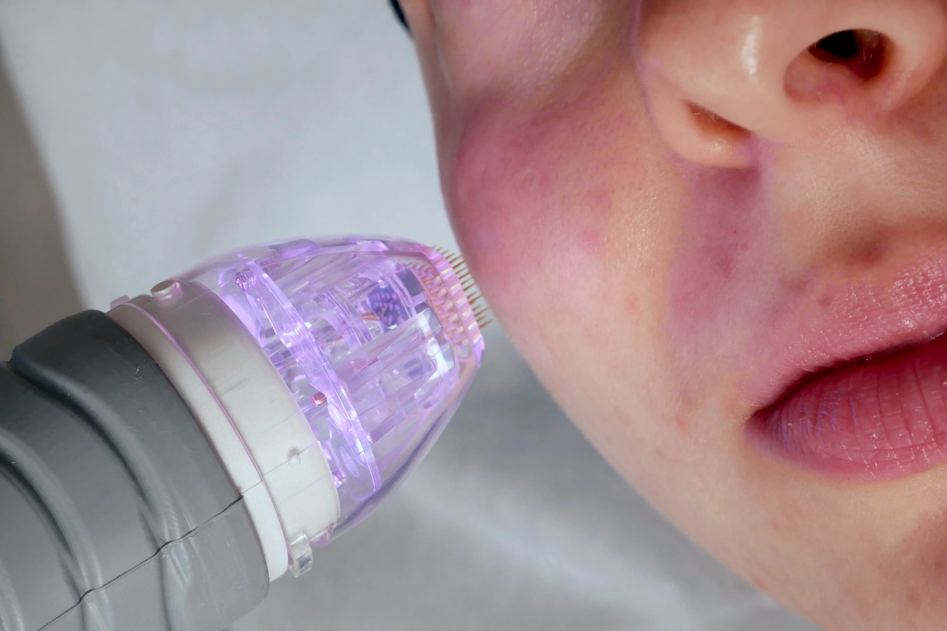 MEDICUM Longevity & Beauty medycyna estetyczna Toruń kosmetologia zabiegi odmładzające poprawa jakości skóry owalu twarzy kolorytu cery radiofrekwencja mikroigłowa grafika