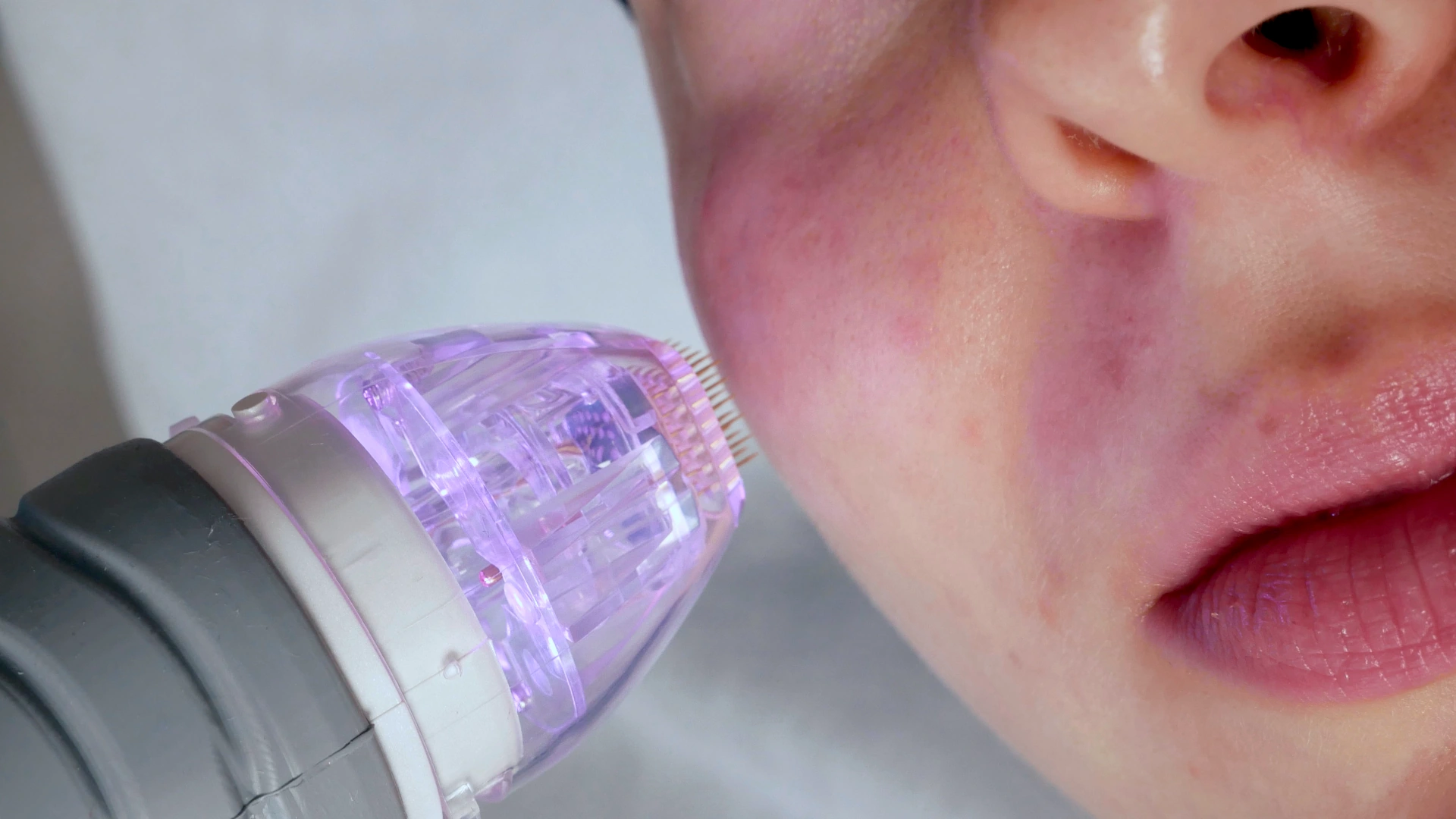 MEDICUM Longevity & Beauty medycyna estetyczna Toruń kosmetologia zabiegi odmładzające radiofrekwencja mikroigłowa poprawa jakości skóry owalu twarzy kolorytu cery